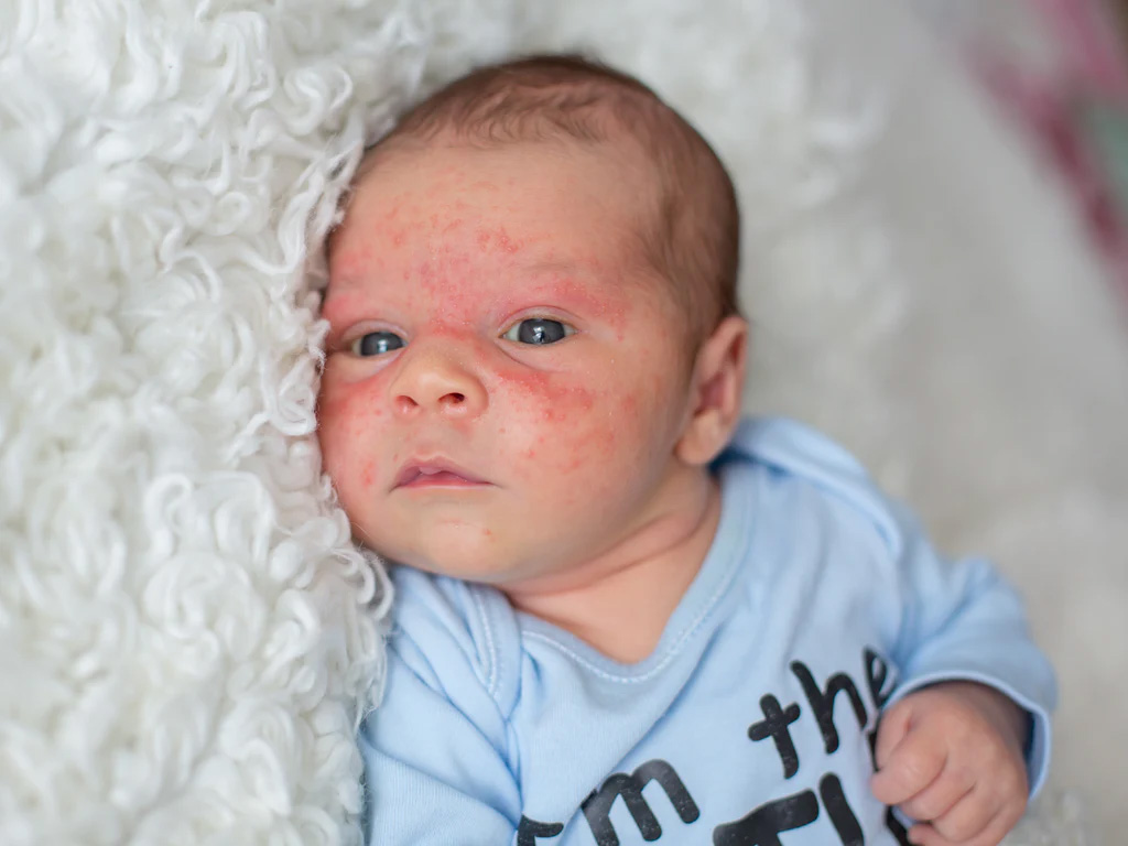 Baby Acne | Breastfeeding 101